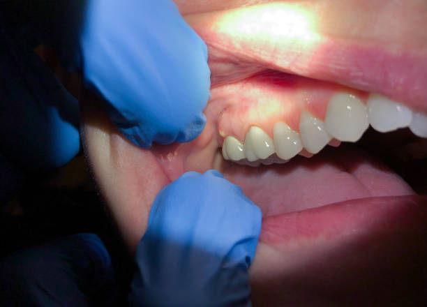 Best Emergency Dental Care for Sports Injuries in Waynesboro, MS